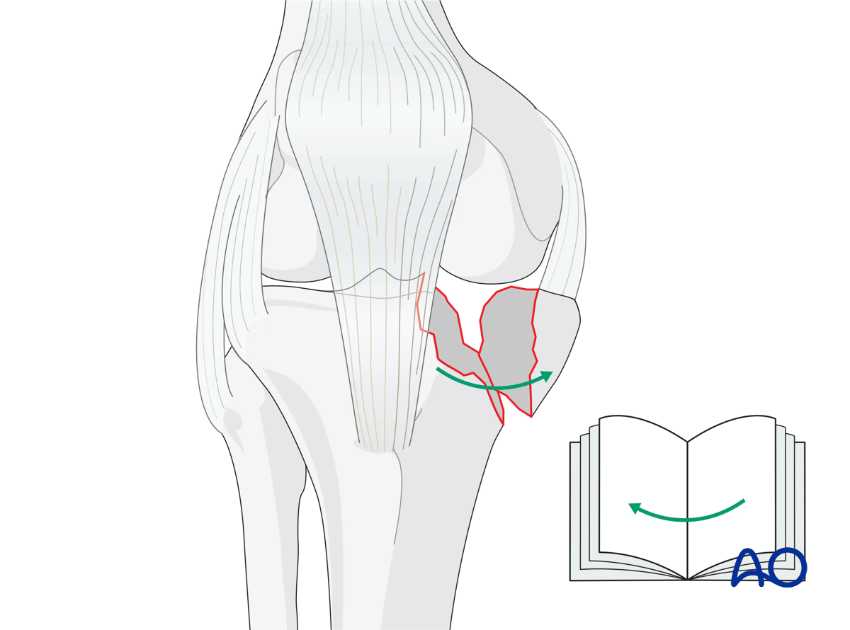 ORIF - Conventional plating, reduction of the medial articular surface