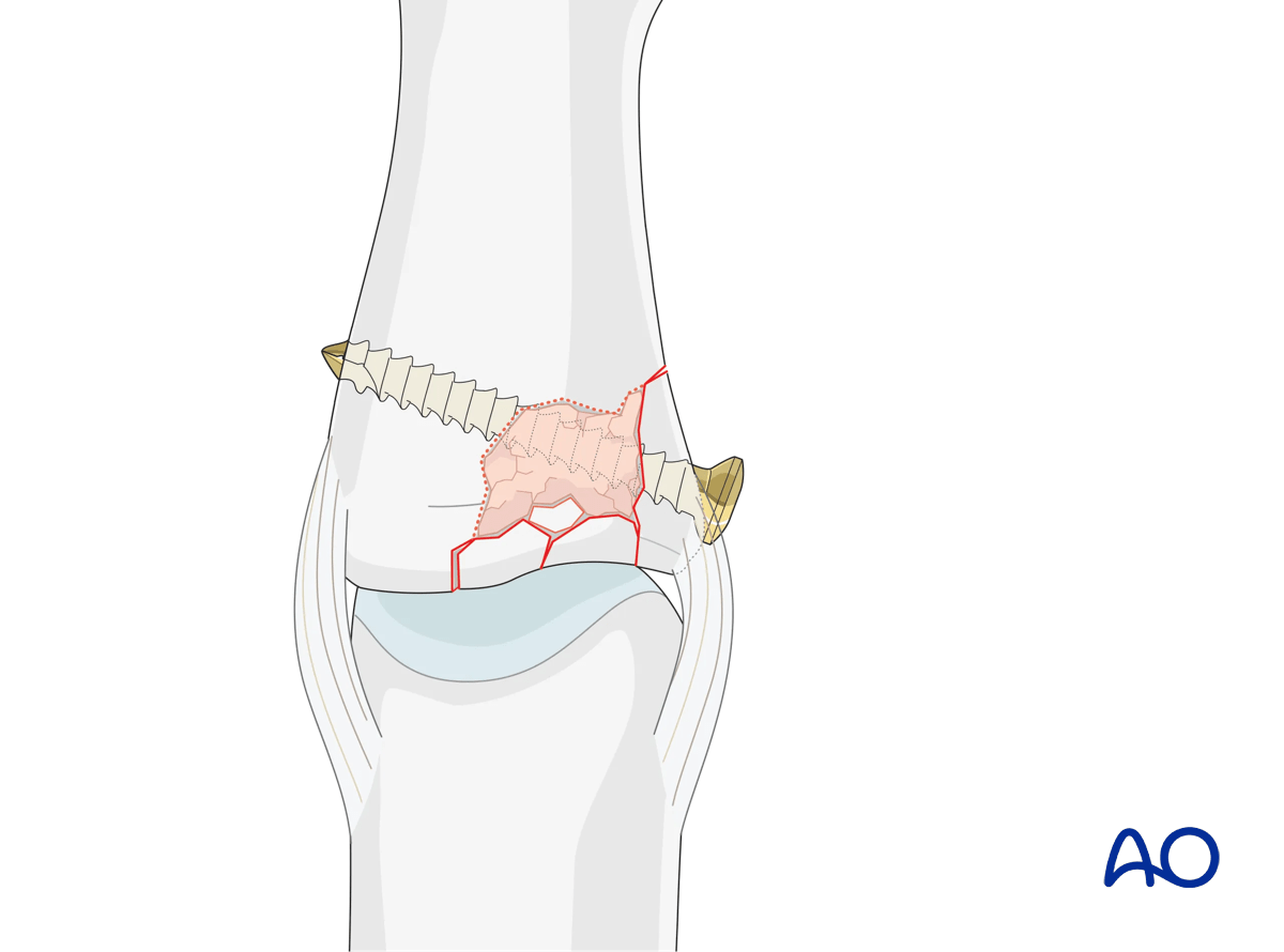 Joint reconstruction of lateral plateau fracture in middle phalangeal base, insert screw, tighten to hold reduction, check congruity.