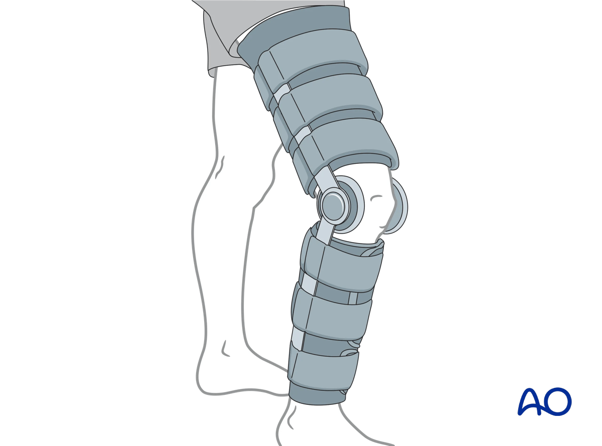 Hinged fracture brace