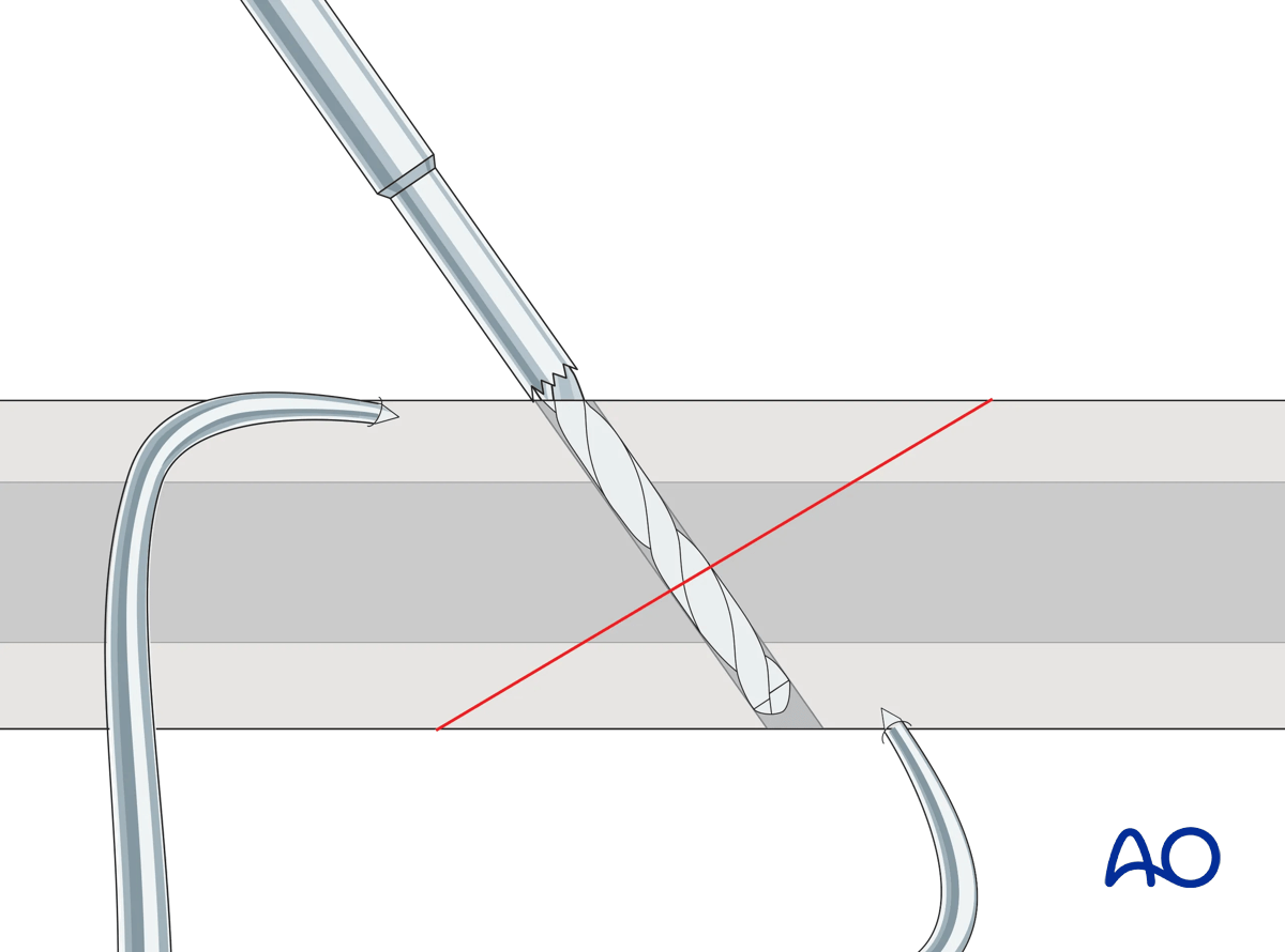Drilling for partially threaded screw