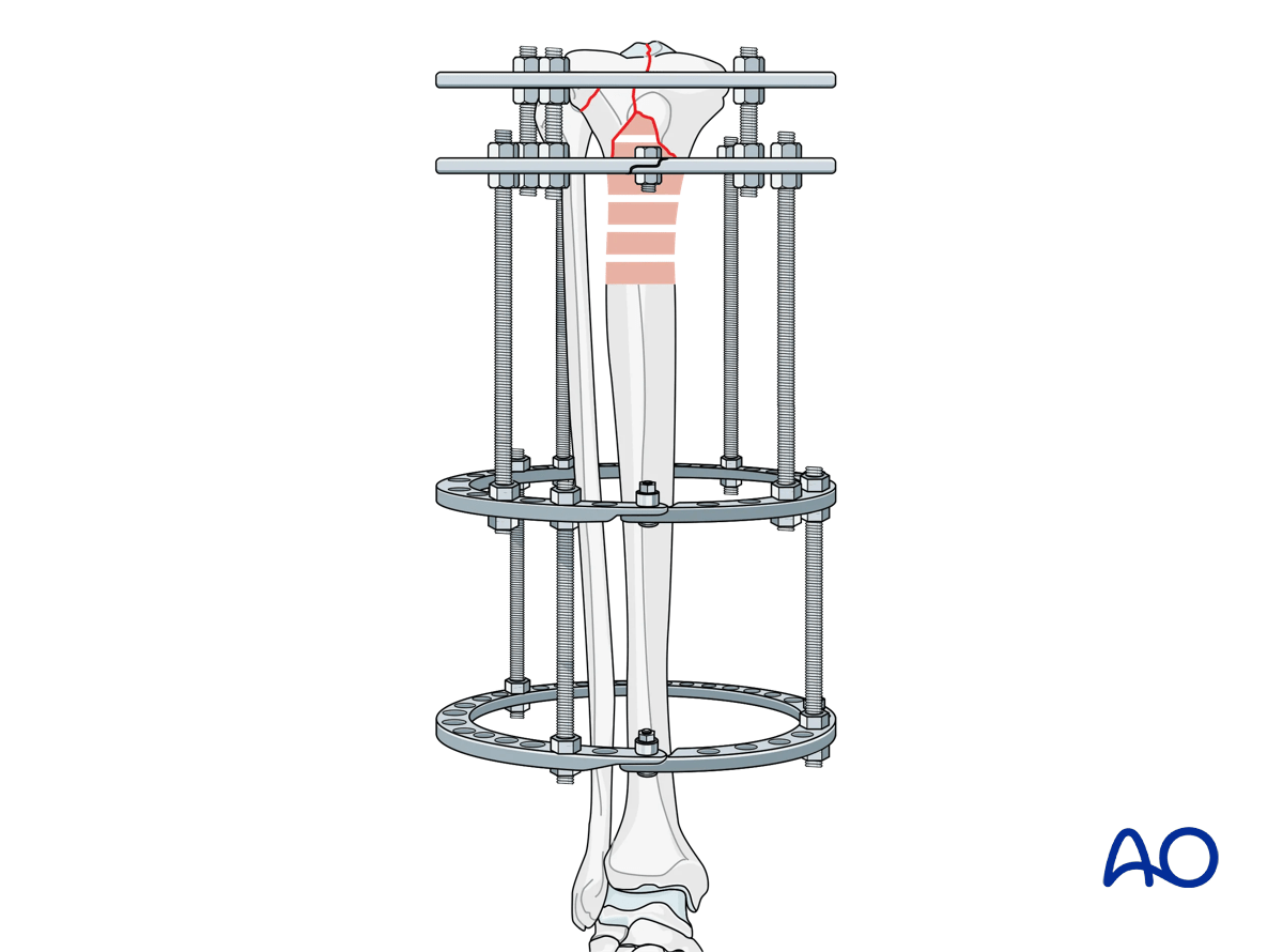 Proximal tibia fracture – ring fixation: frame assembly