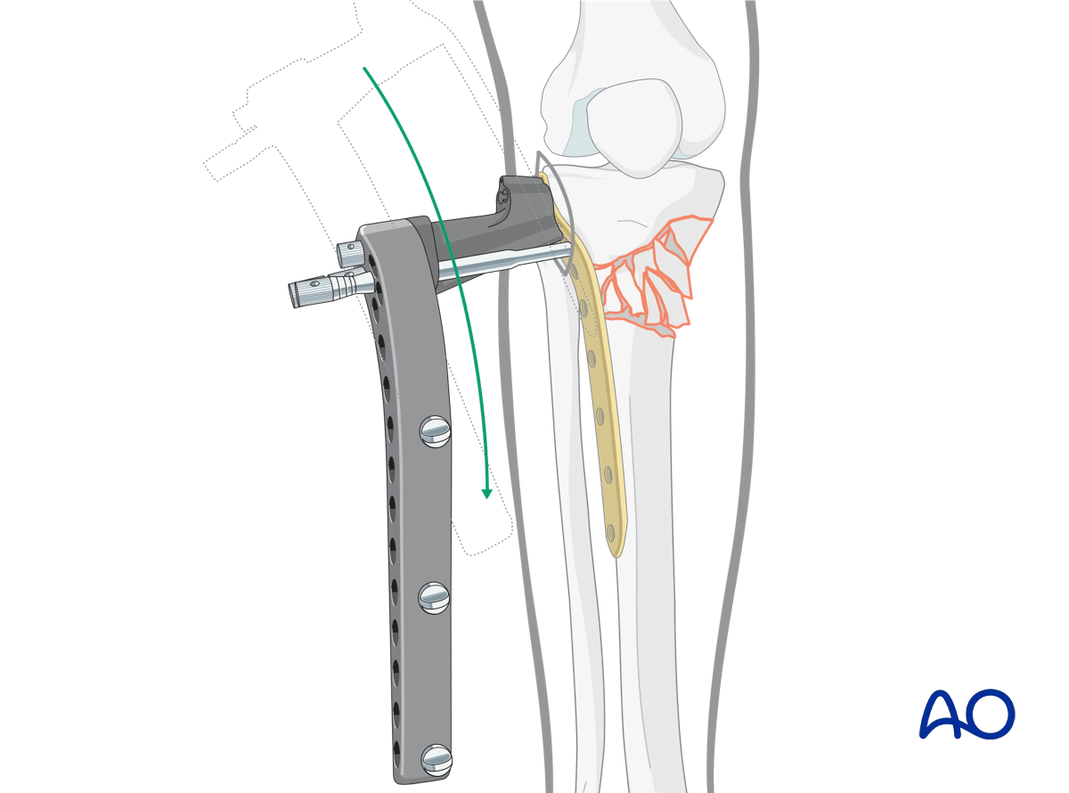 Proximal tibia: Wedge or multifragmentary extraarticular fracture Angular stable plating – plate insertion