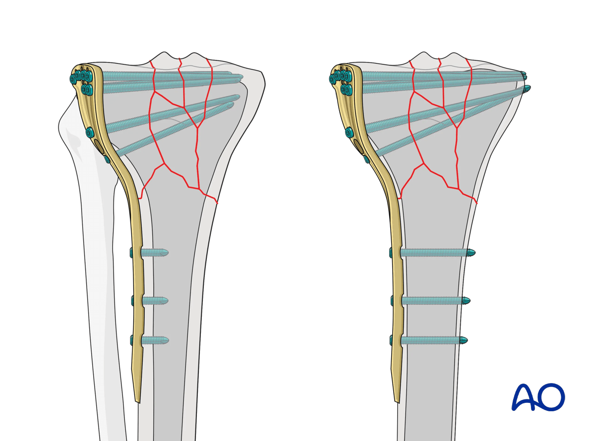 Proximal tibia: complete articular fracture - Angular stable plating – preoperative planning