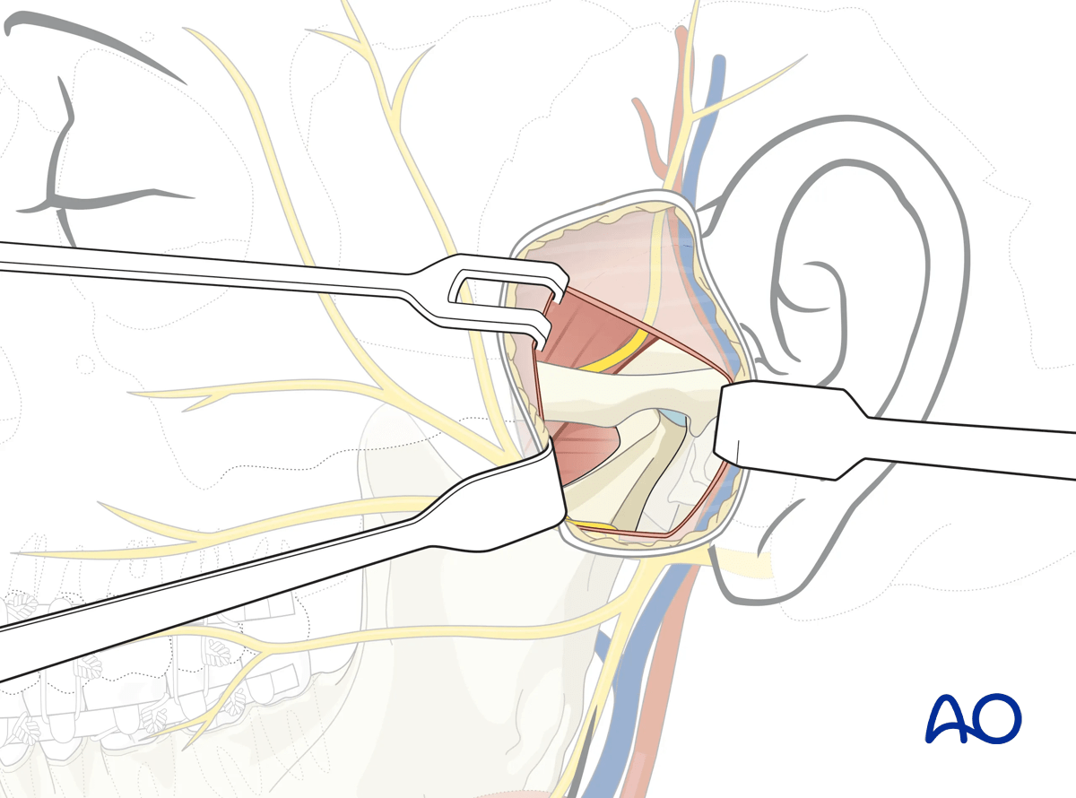 Endaural approach to the condyle: access and amount of exposure