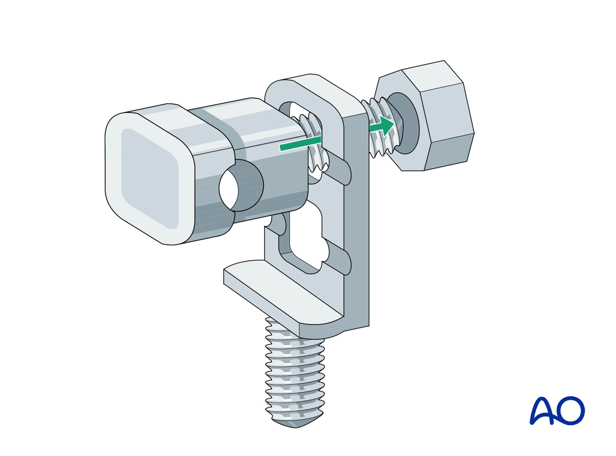 Proximal tibia fracture – ring fixation: Schanz screw mounting with multiparallel pin clamp