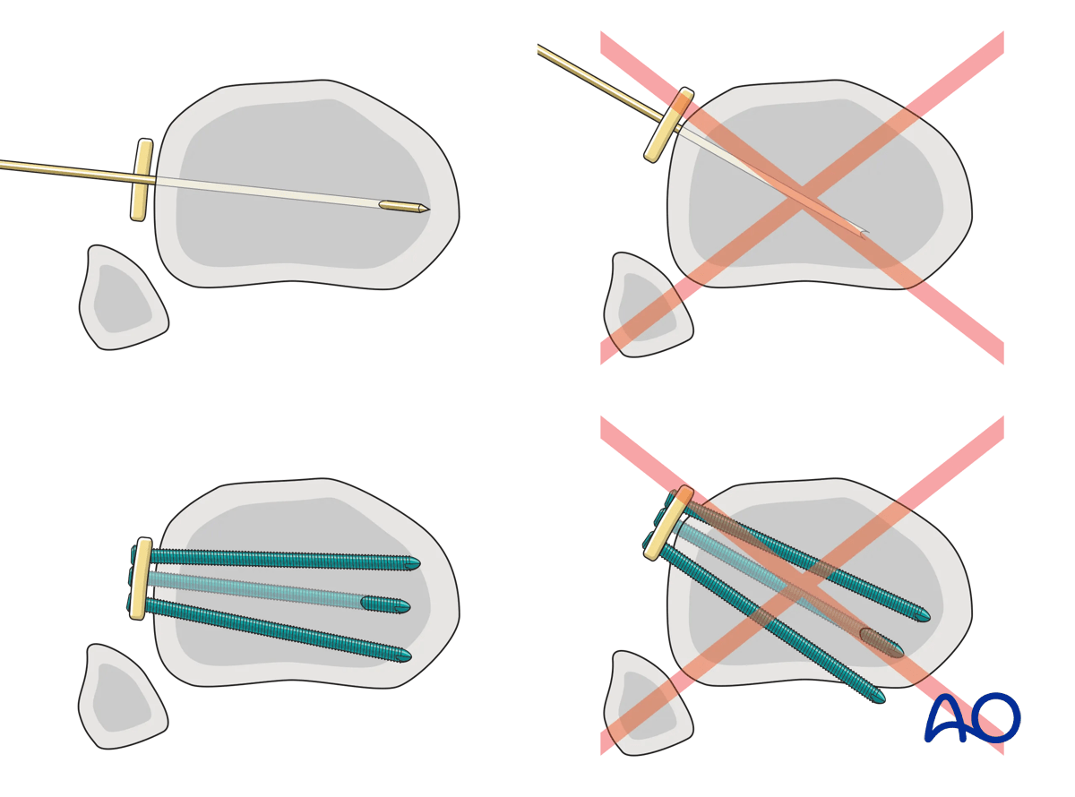 Proximal tibia: Wedge or multifragmentary extraarticular fracture Angular stable plating – plate positioning