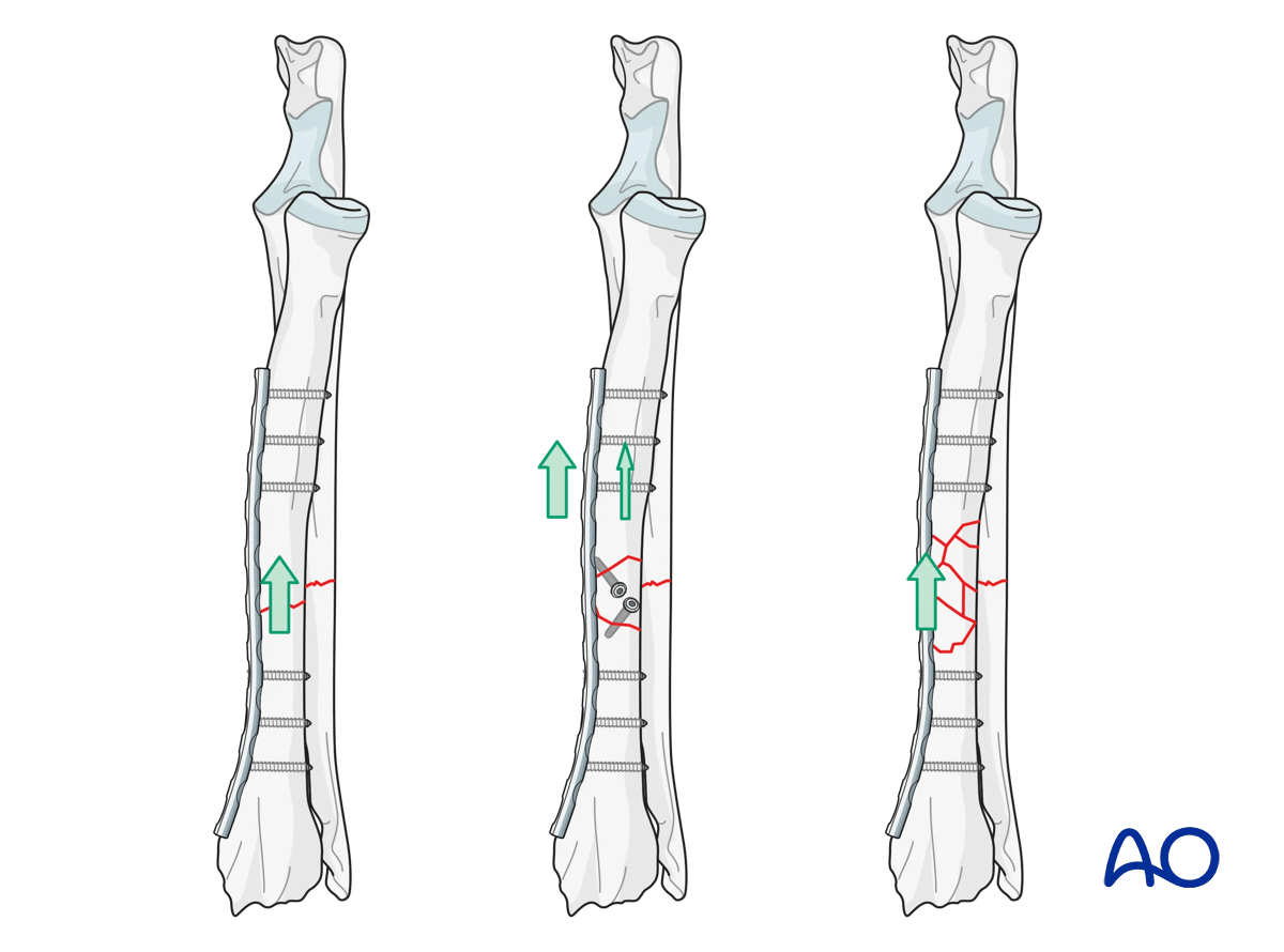 Plating of various radial shaft fractures in the dog