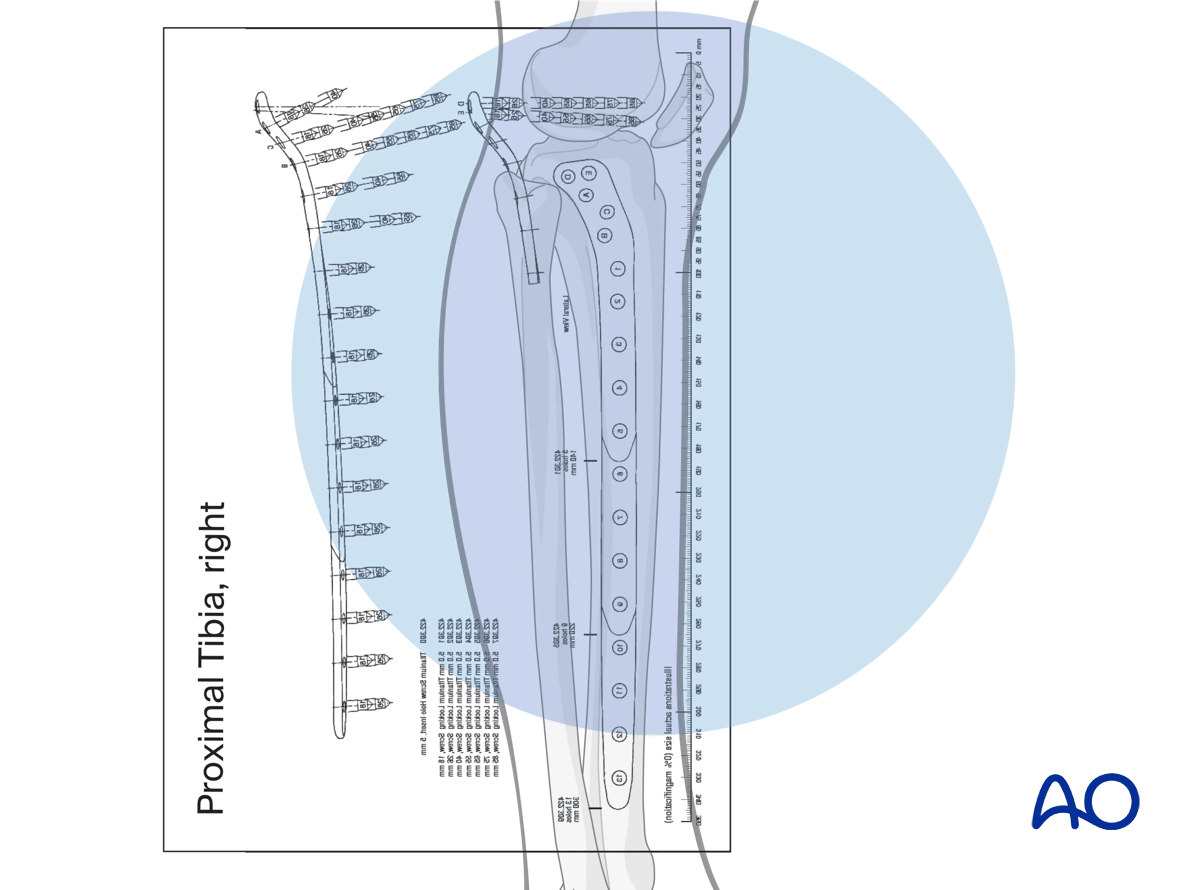 Proximal tibia fractures – planning plate length