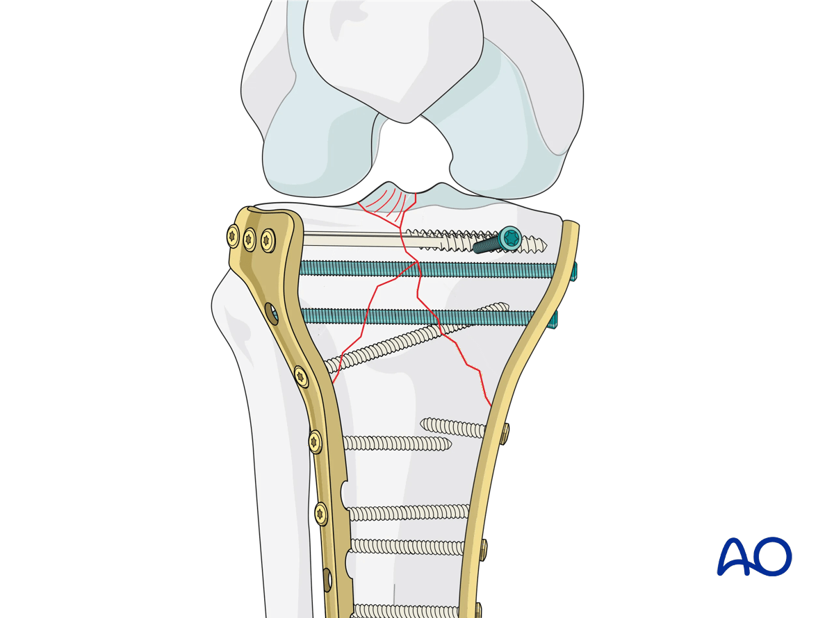 Proximal tibia: complete simple articular fracture with fragmentary metaphyseal components fixed with ORIF conventional plating