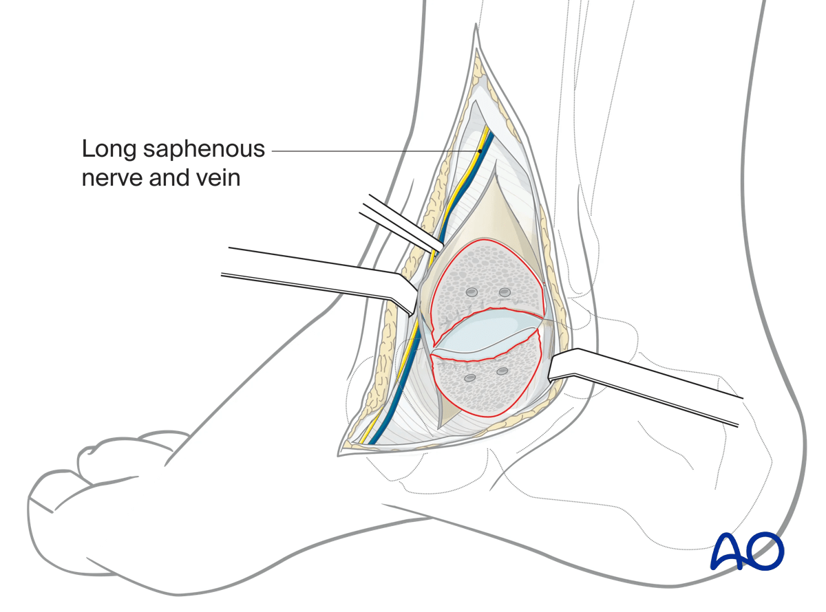 Medial malleolar osteotomy reflect medial malleolus distally; avoid excessive retraction to protect deltoid artery branch.