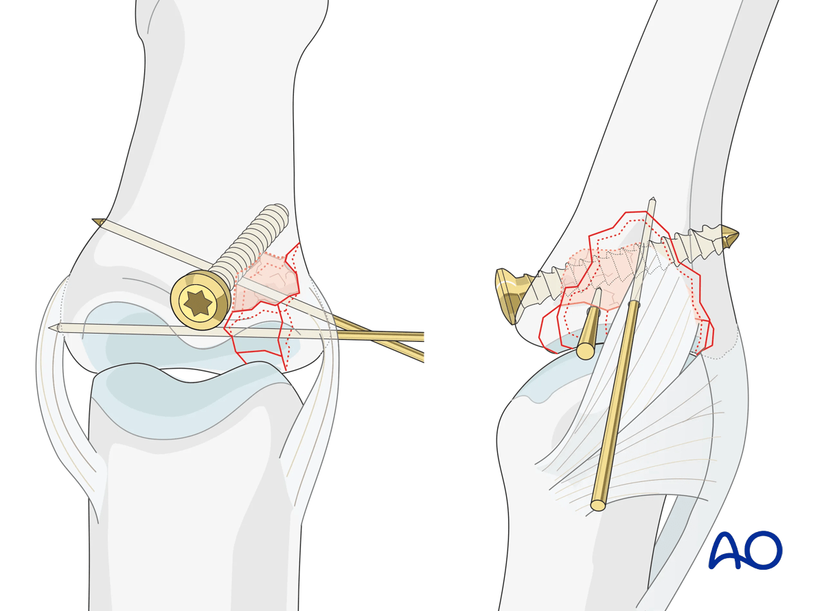 Joint reconstruction of lateral plateau fracture in middle phalangeal base, use antiglide plate, avoid fragmenting bone.