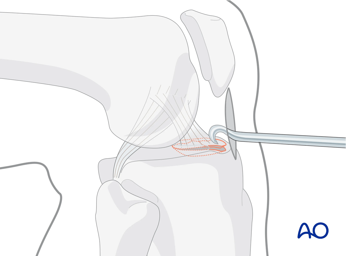 Extraarticular fracture, avulsion of tibial spine: reduction with shoulder hook
