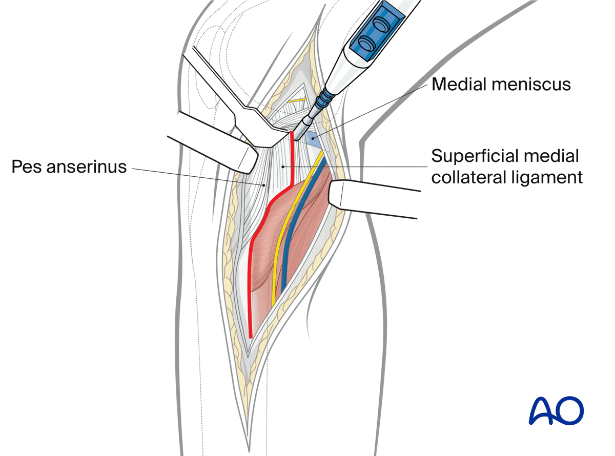 Medial/posteromedial approach to the proximal tibia, Opening of the knee joint