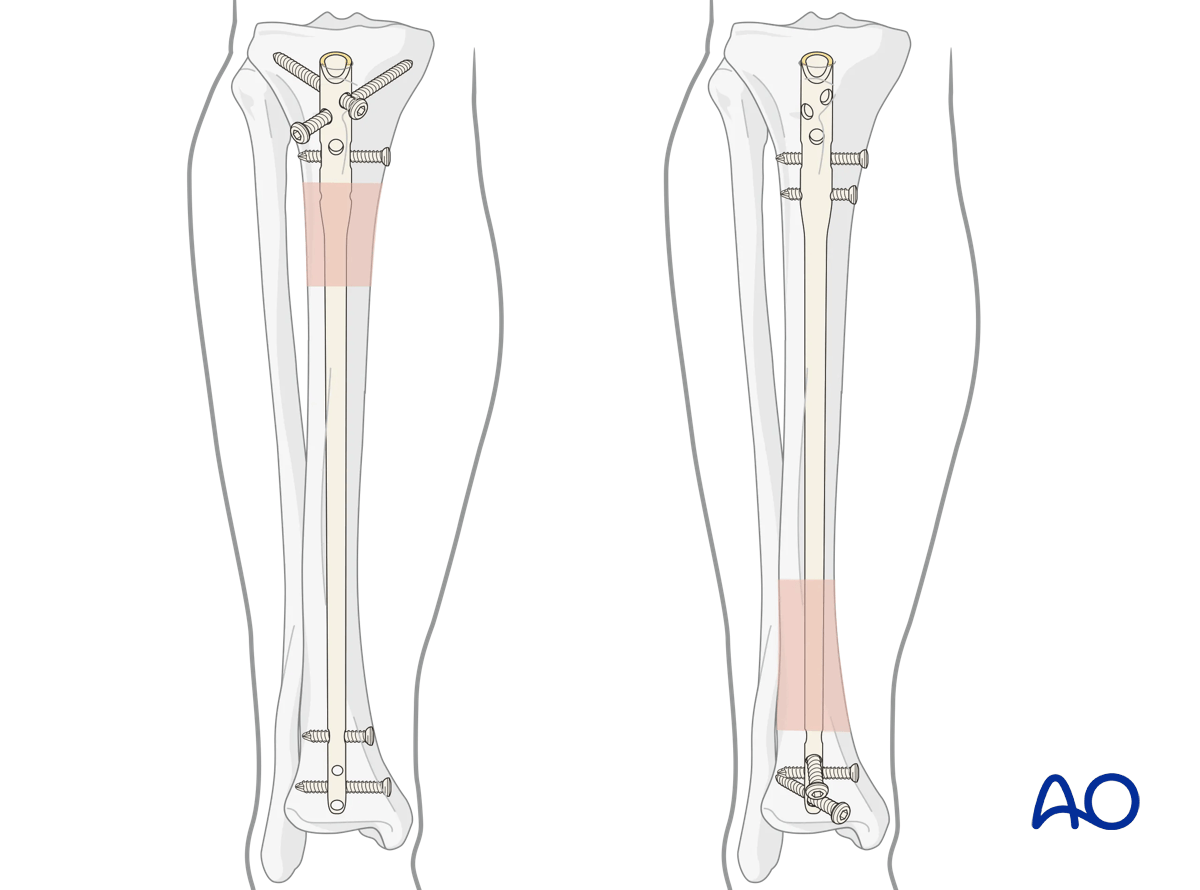 Intramedullary nailing of proximal and distal tibial shaft fractures