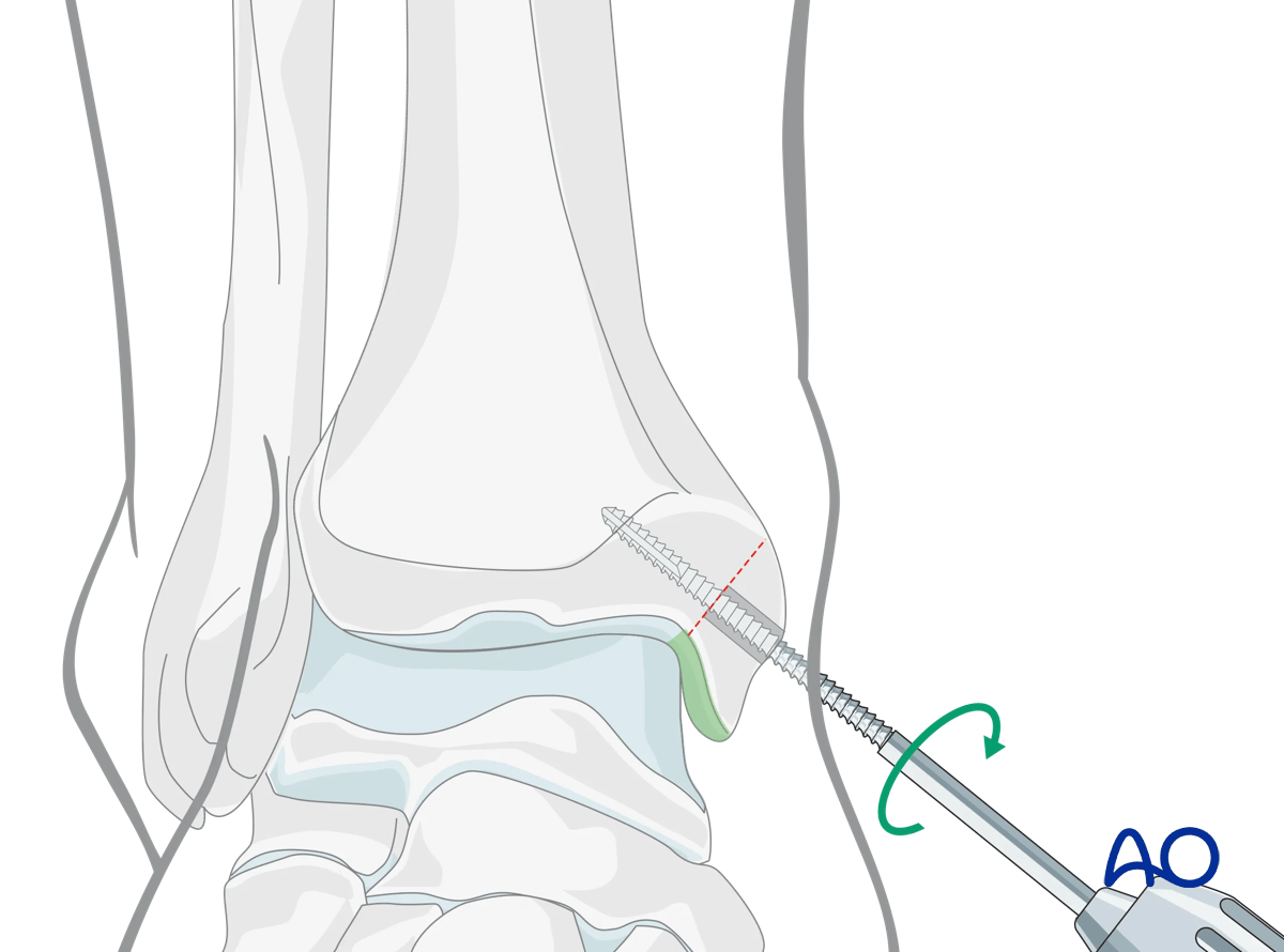 Medial malleolar osteotomy avoids tibial plafond; joint surface visualized; predrill two parallel lag screws.
