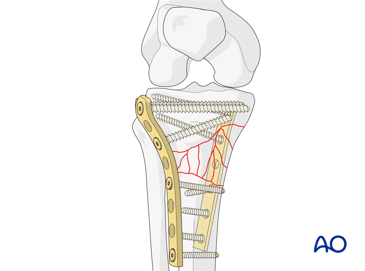 Proximal tibia: Wedge or multifragmentary extraarticular fracture: ORIF - Conventional plating, final construct