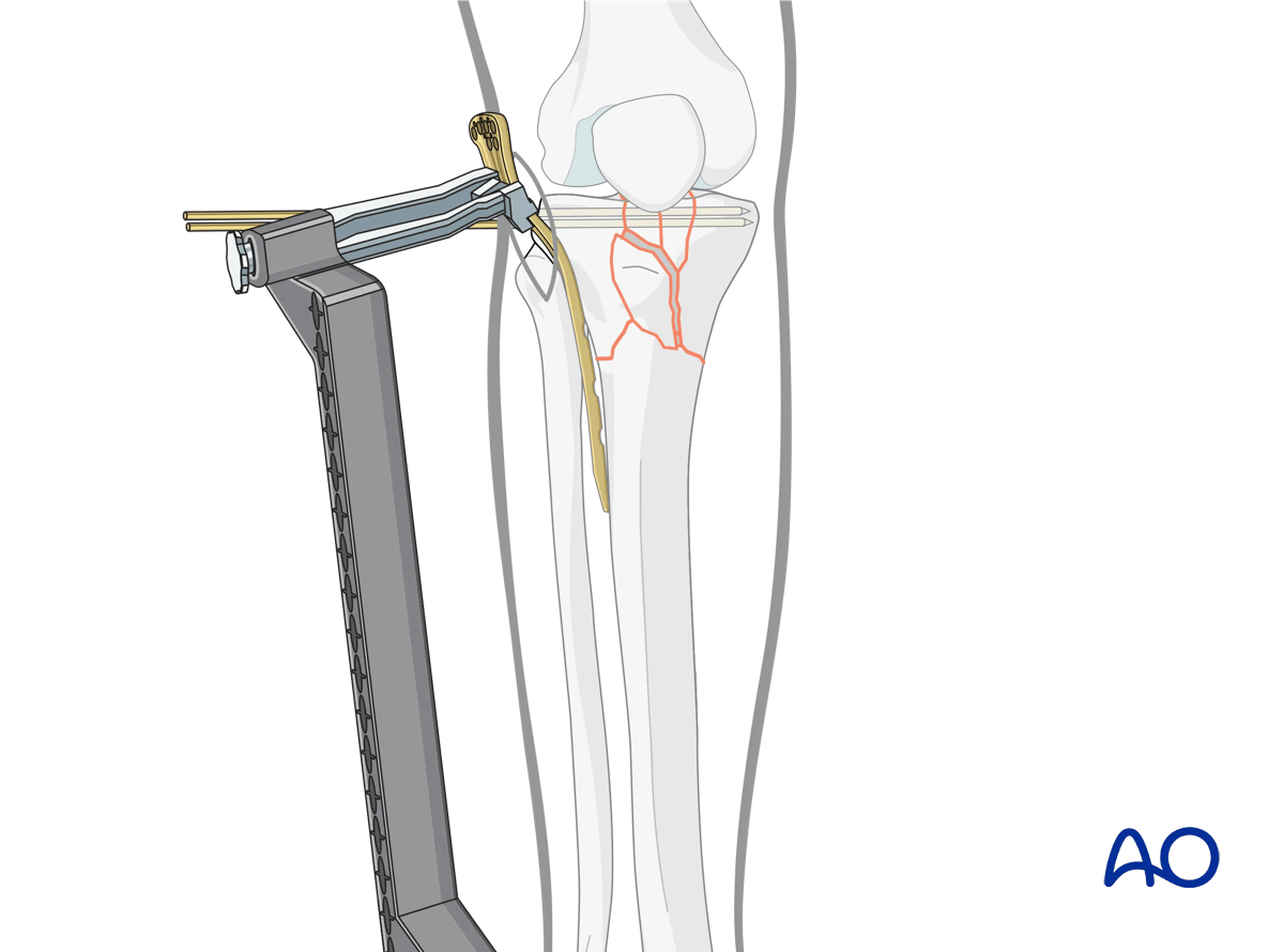 Proximal tibia: complete articular fracture - Angular stable plating – preliminary fixation