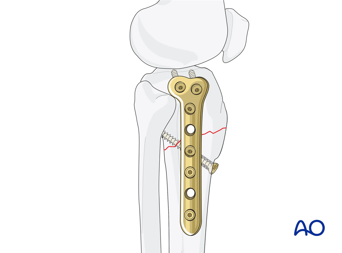 ORIF - Conventional plating, fixation
