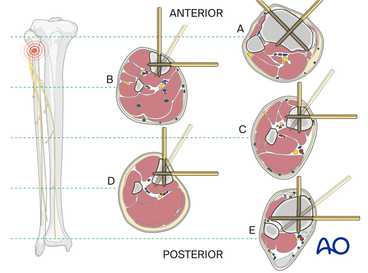 Safe zones in the tibia for Schanz screw insertion