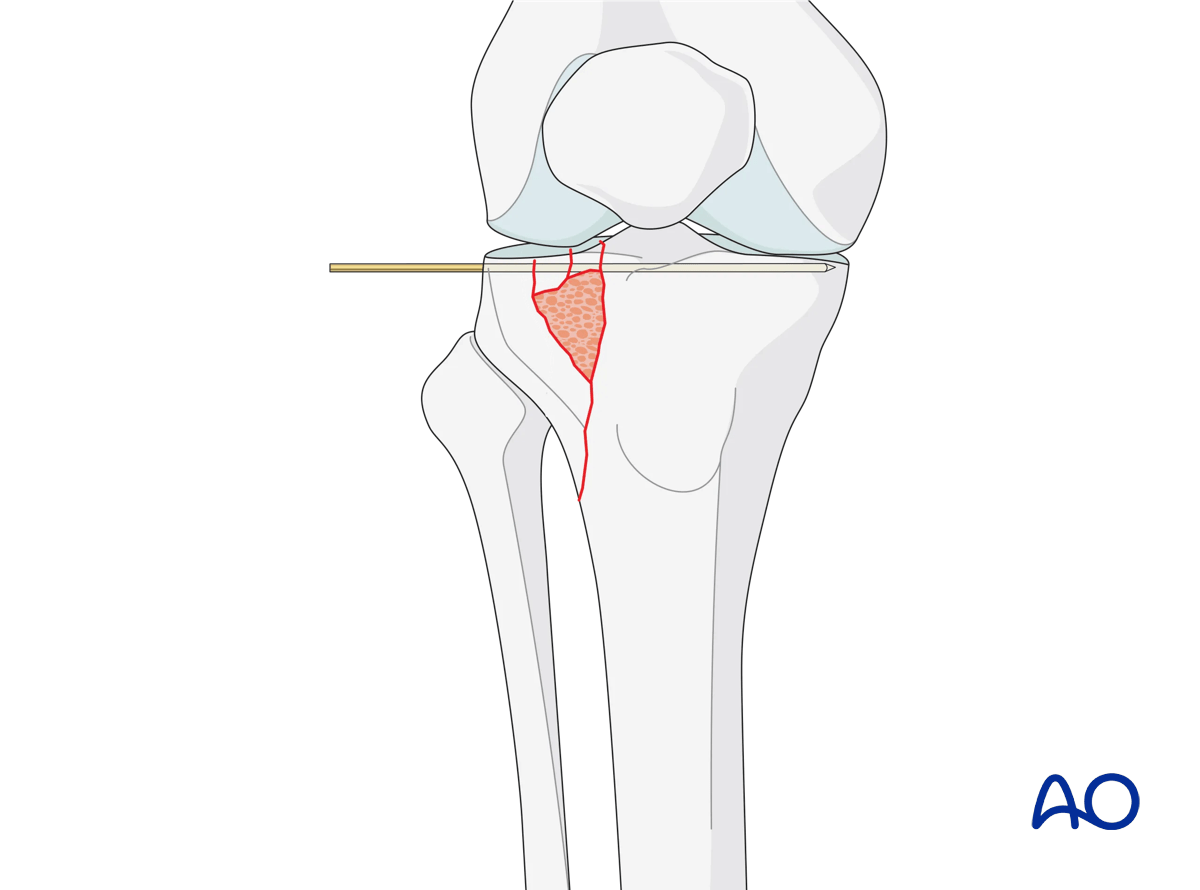 Proximal tibia Lateral plateau split-depression fracture – ORIF conventional plating – final construct: reduction of the lateral articular surface
