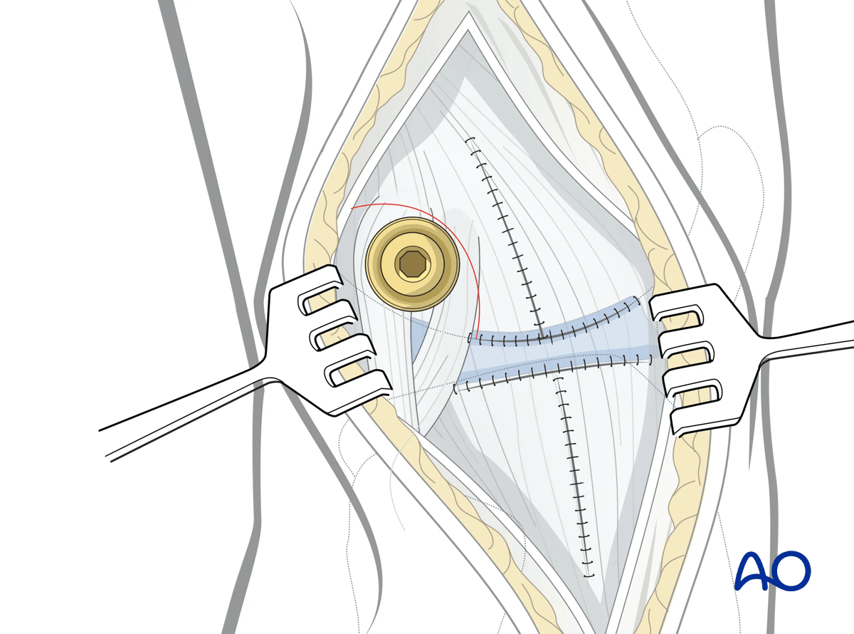 Extended anterolateral approach to the proximal tibia: closure