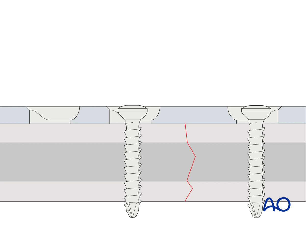 Screw insertion in compression mode