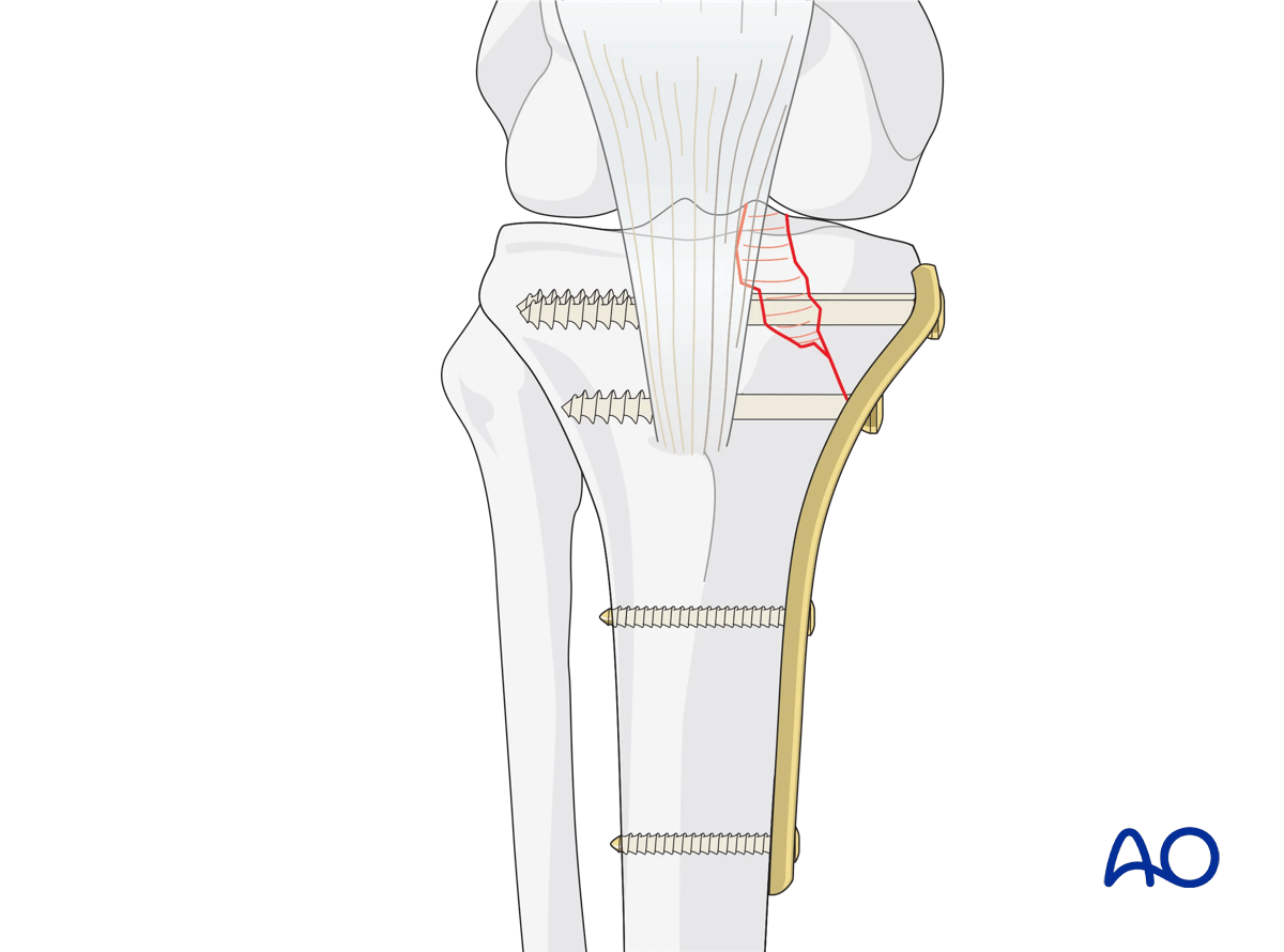 ORIF - Conventional plating, Partial articular fracture split depressed medial