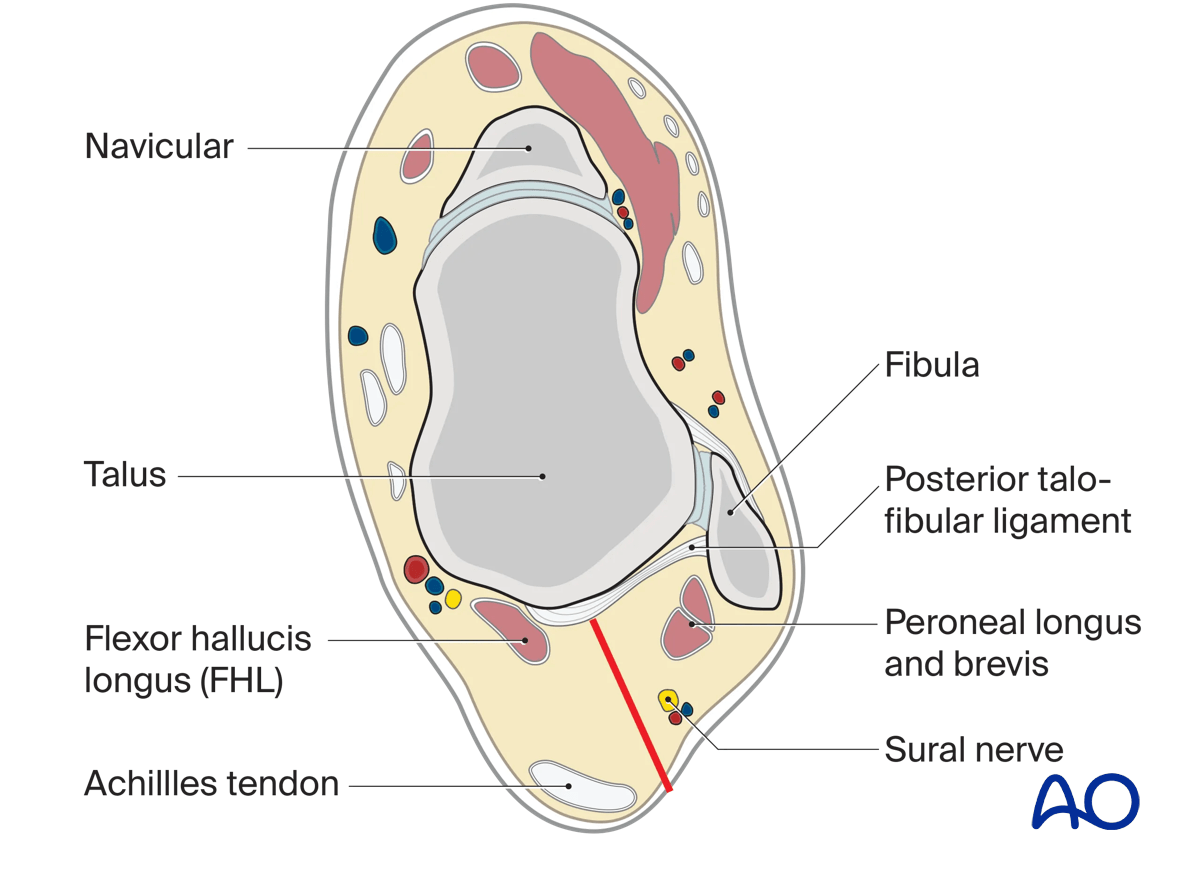 Position incision posterior to avoid sural nerve superiorly.