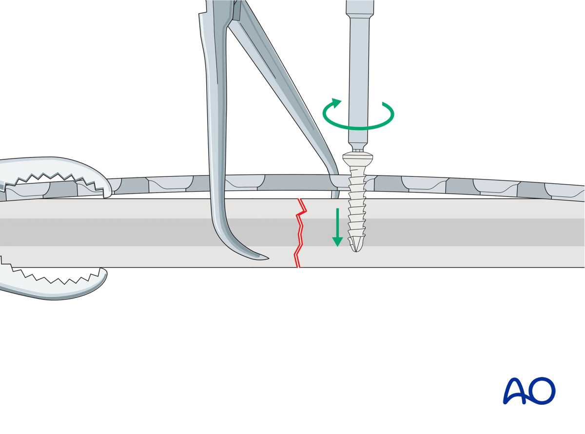 Illustration showing a prebent plate fixed to a main fragment with a screw in compression mode, reduction forceps holding the opposite fragment, and the screw not fully tightened.