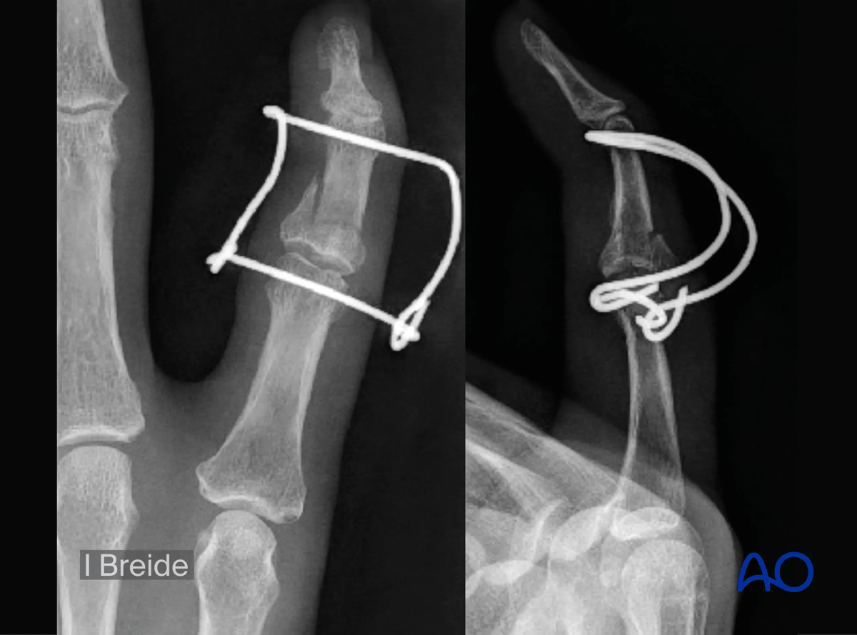 Dynamic external fixation of a multifragmentary complete articular fracture of the middle phalangeal base.