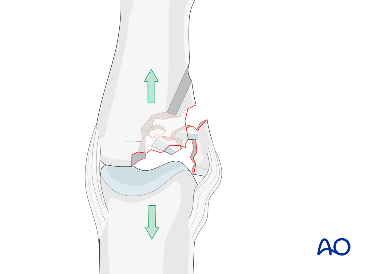 Joint reconstruction of lateral plateau fracture in middle phalangeal base, direct reduction needed, bone graft support.