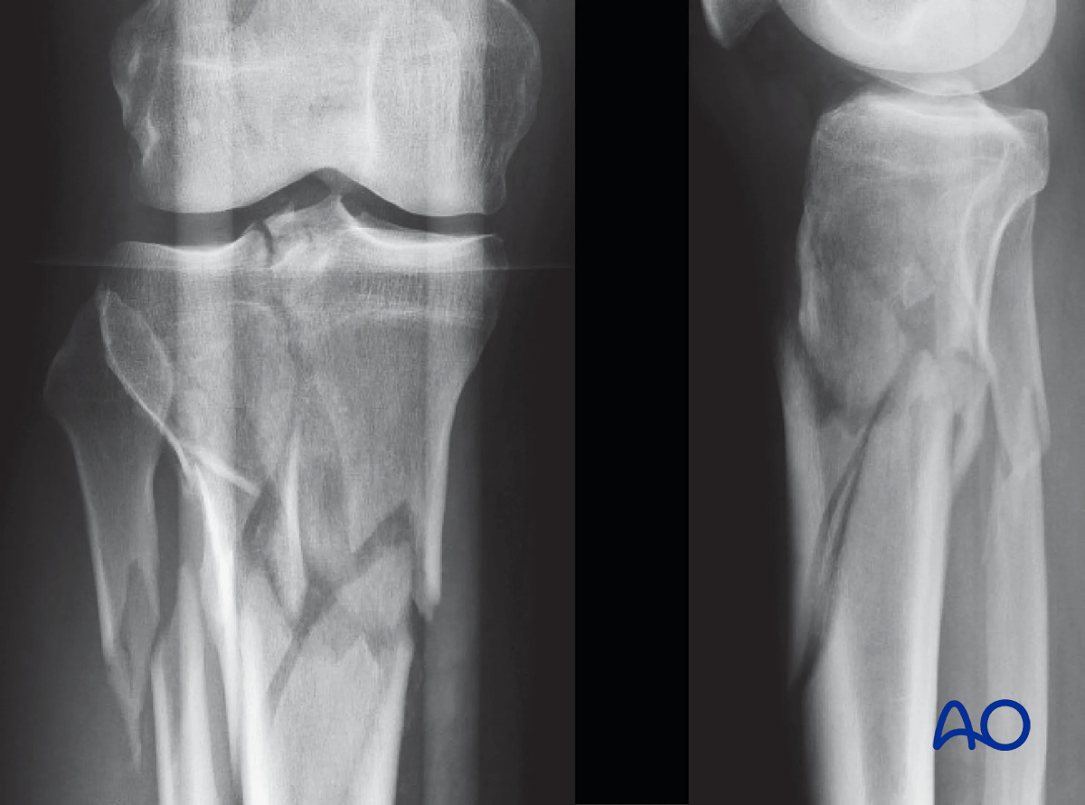 Proximal tibia fracture – a closed injury of the type 41.C2.2