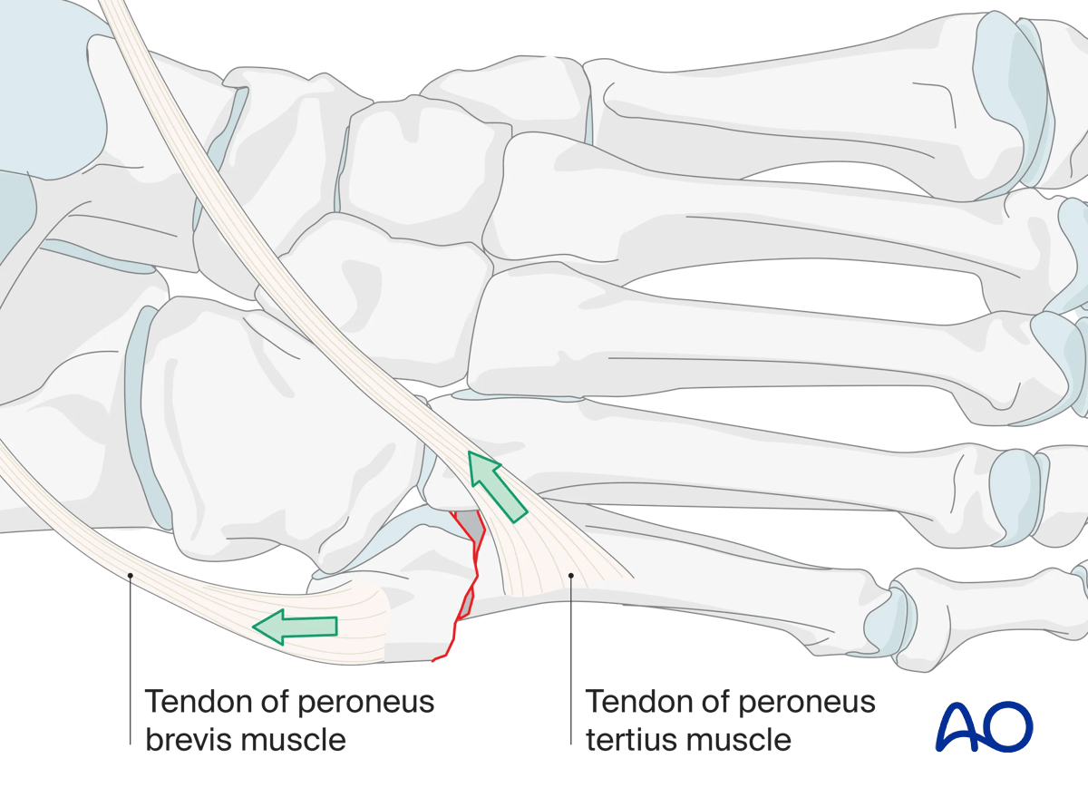 Proximal articular fractures of the 5th metatarsal (Jones fracture)