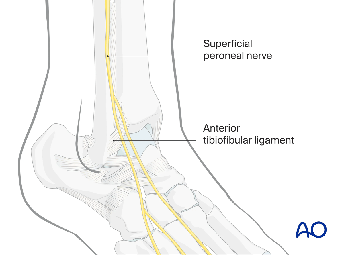 Lateral malleolar osteotomy superficial peroneal nerve lies anterior to fibula; variable course—protect during approach