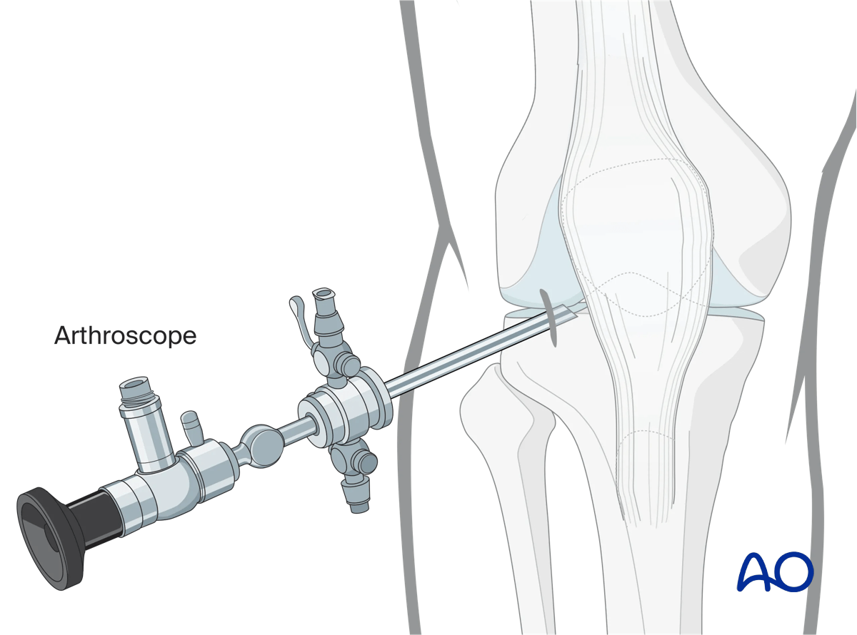 Arthroscopic approach to the knee, Anterolateral incision