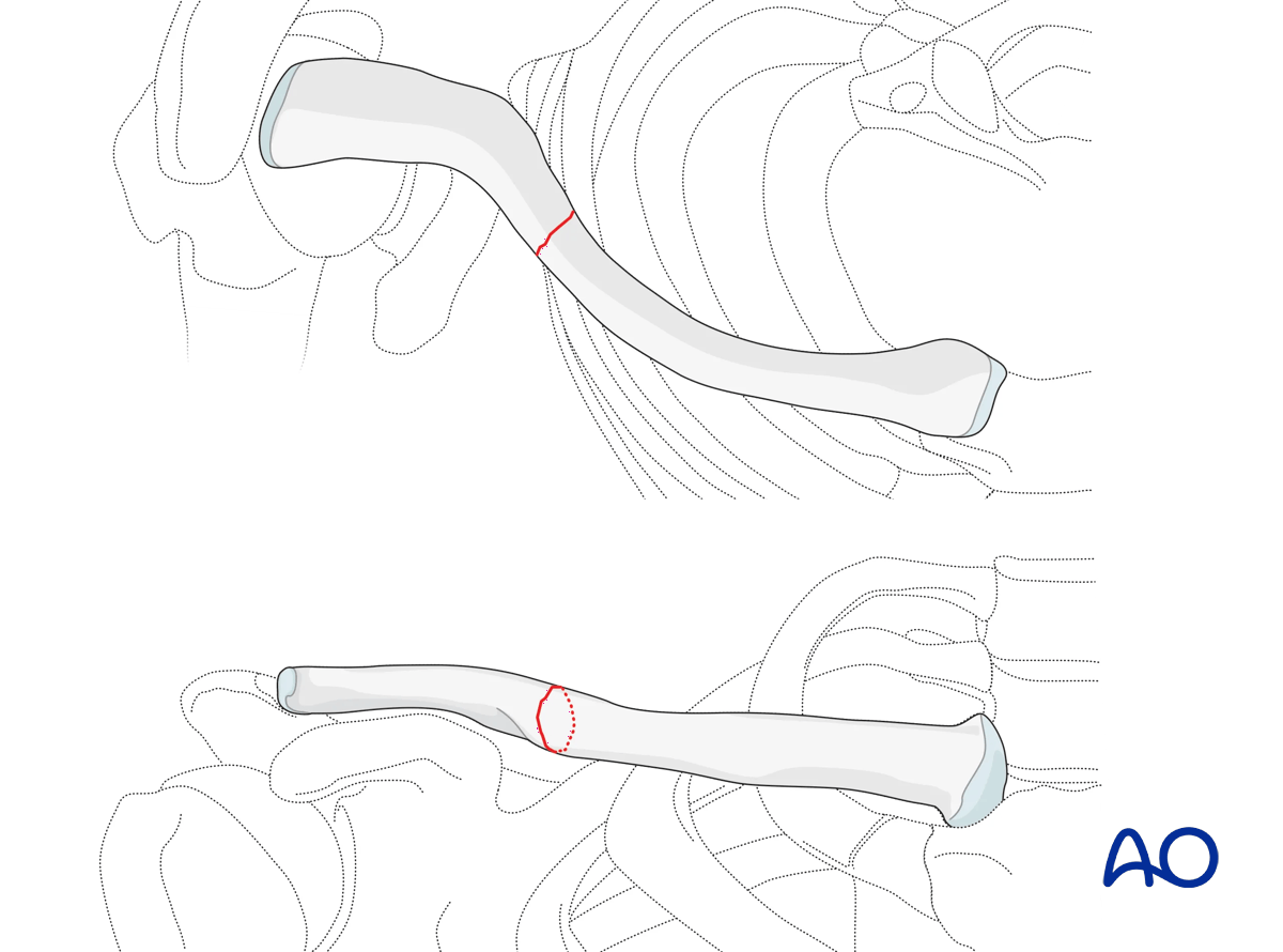 Clavicle: diaphyseal simple, transverse fracture