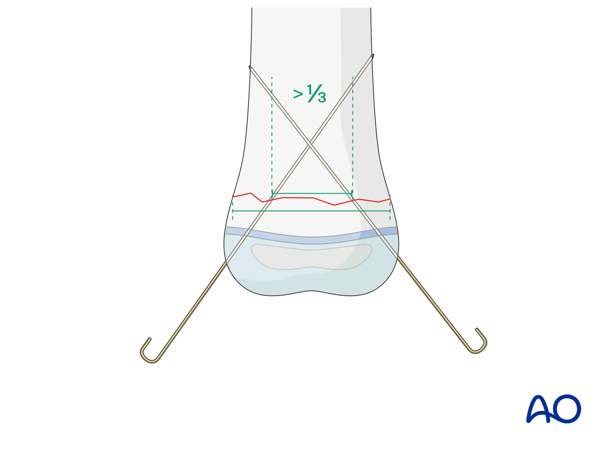 K-wire fixation of a transverse metaphyseal fracture in a pediatric patient with open physis