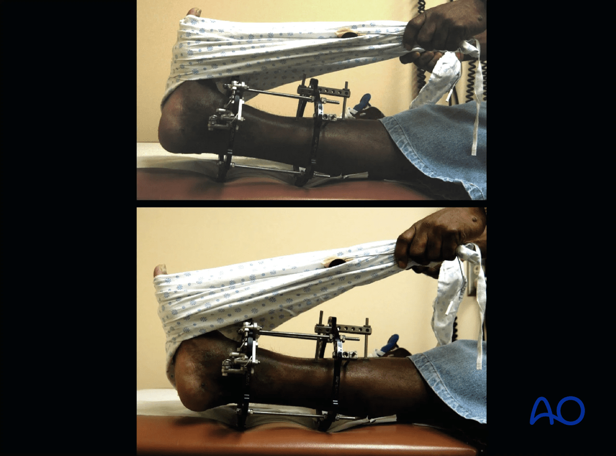 Proximal tibia fracture – ring fixation: active and passive range of motion of the ankle in the frame