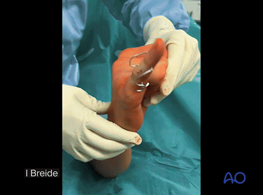 Dynamic external fixation of a multifragmentary complete articular fracture of the middle phalangeal base.